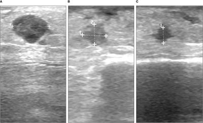 Case report: Therapeutic potential of T-VEC in combination with MEK inhibitors in melanoma patients with NRAS mutation
